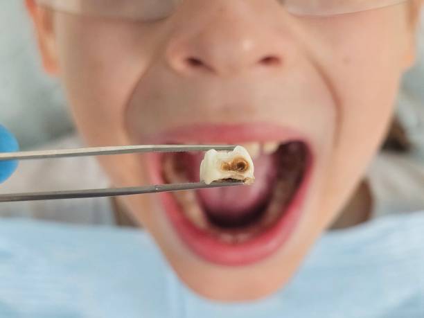 Best Emergency Dental Care for Broken or Chipped Teeth in Glide, OR